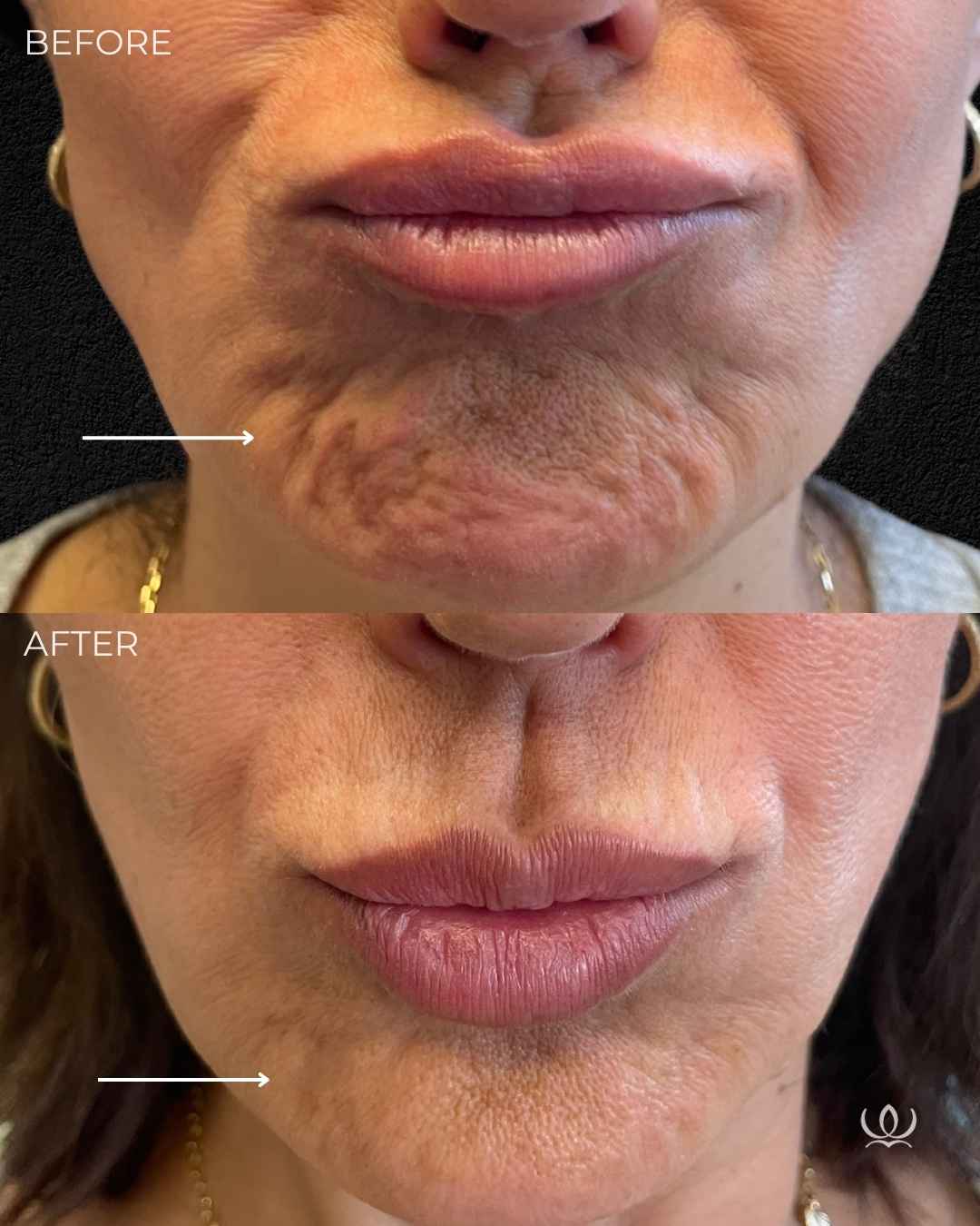 Chin dimpling before and after — West Empire Aesthetics, Brentwood