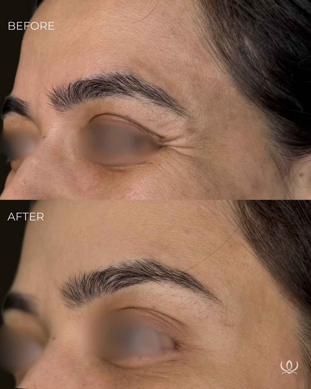 Crow's feet before and after — West Empire Aesthetics, Brentwood