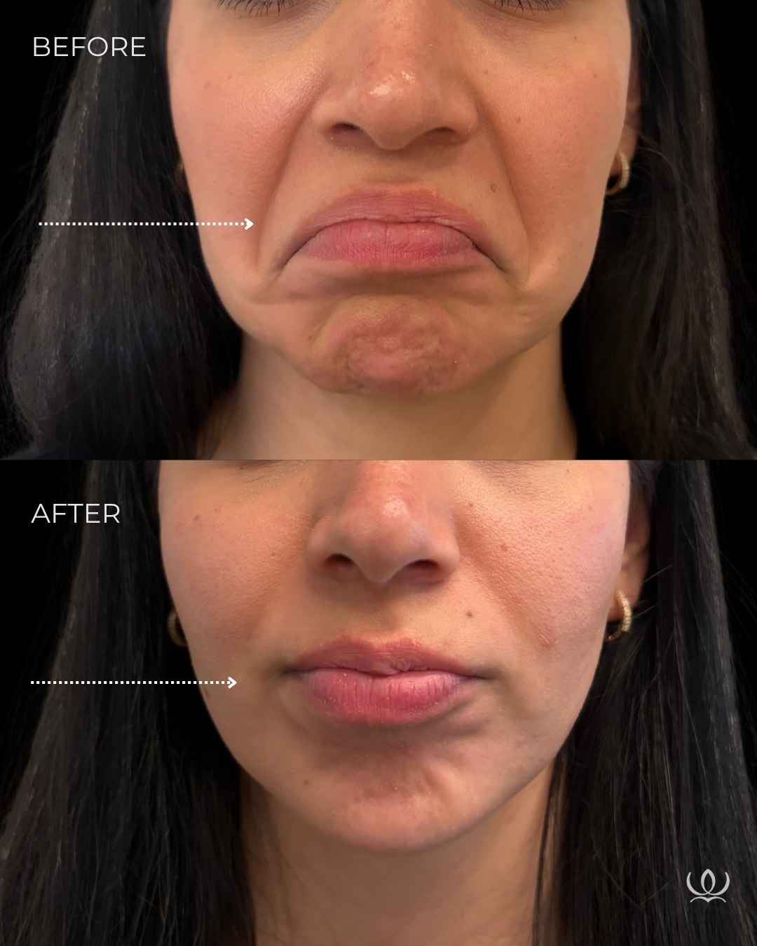 DAO + chin before and after — West Empire Aesthetics, Brentwood
