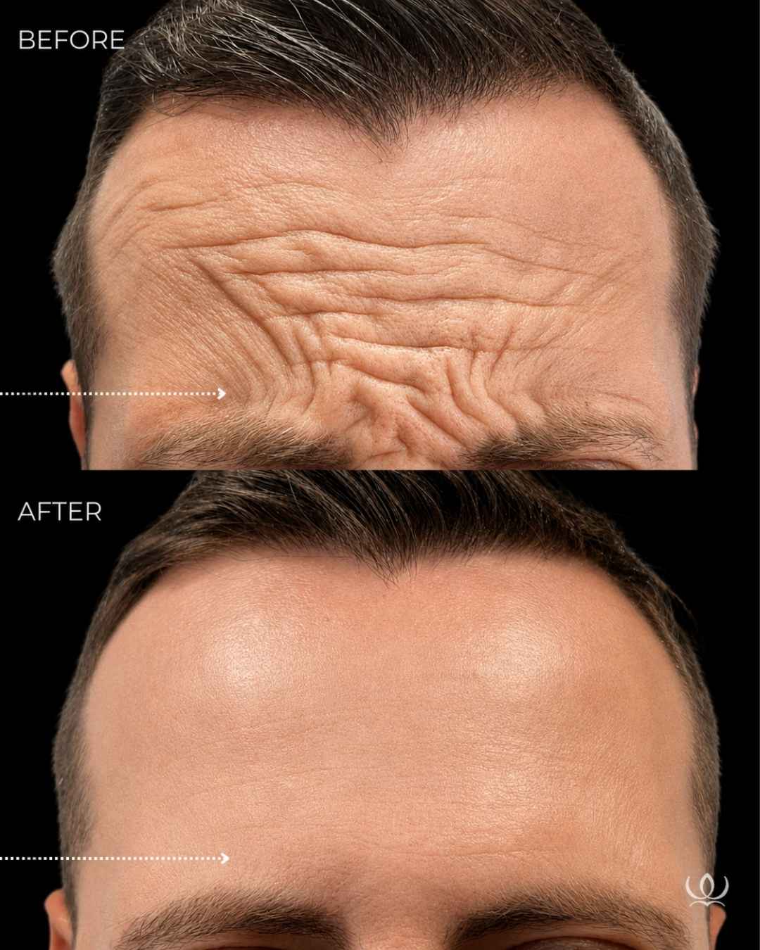 Frown lines — the 11s before and after — West Empire Aesthetics, Brentwood