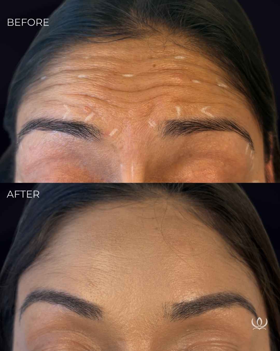Forehead lines before and after — West Empire Aesthetics, Brentwood