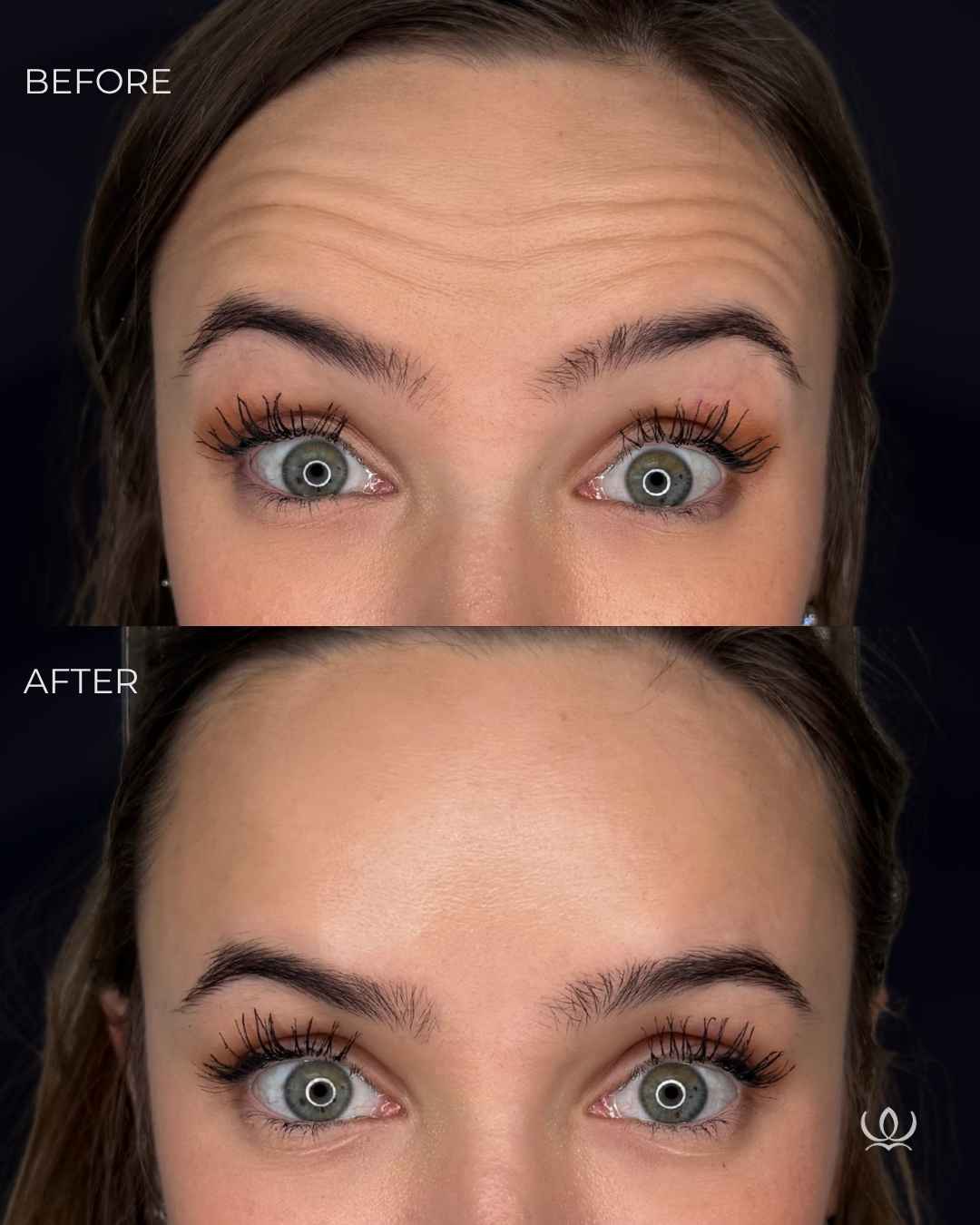 Forehead lines before and after — West Empire Aesthetics, Brentwood