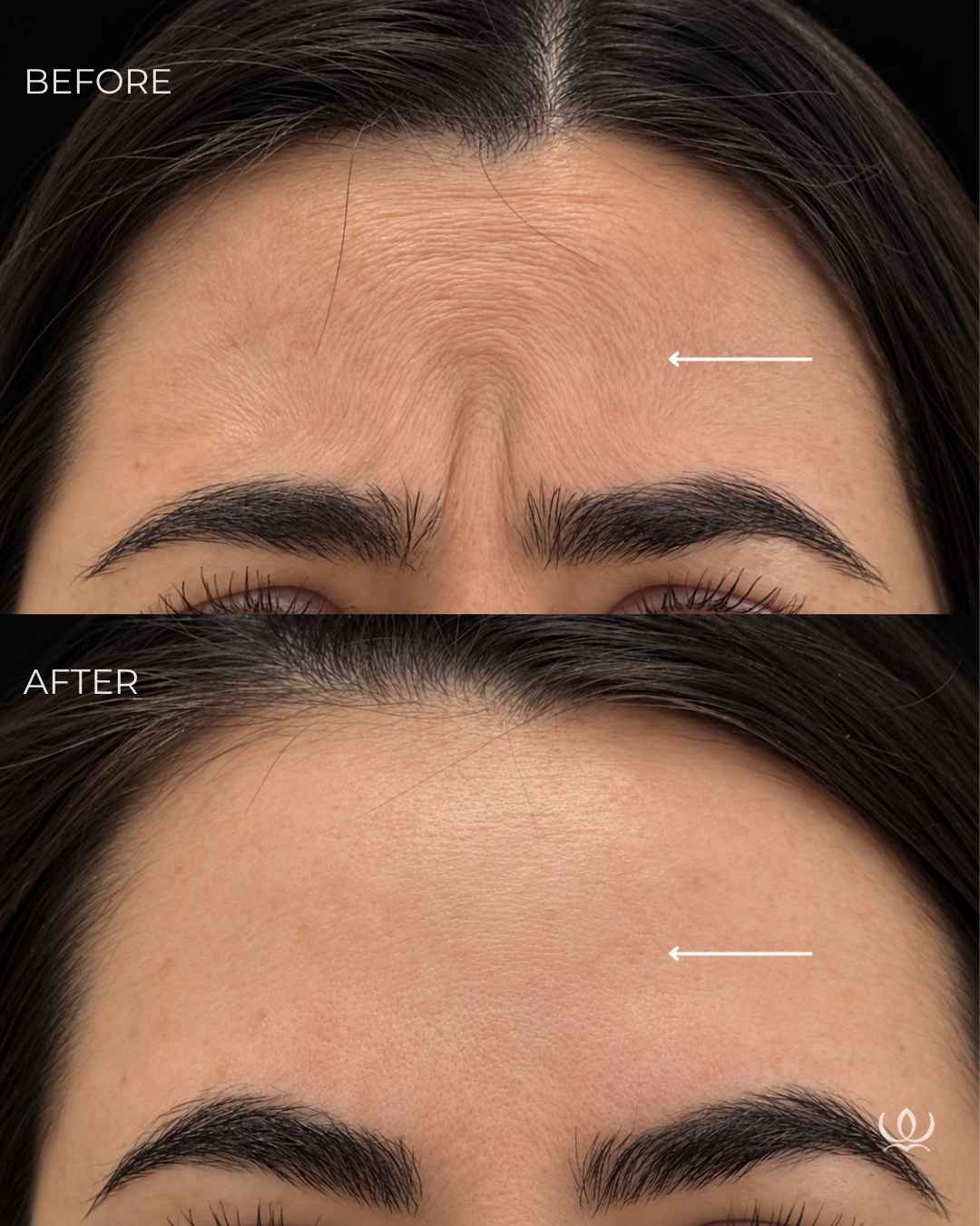 Forehead lines before and after — West Empire Aesthetics, Brentwood