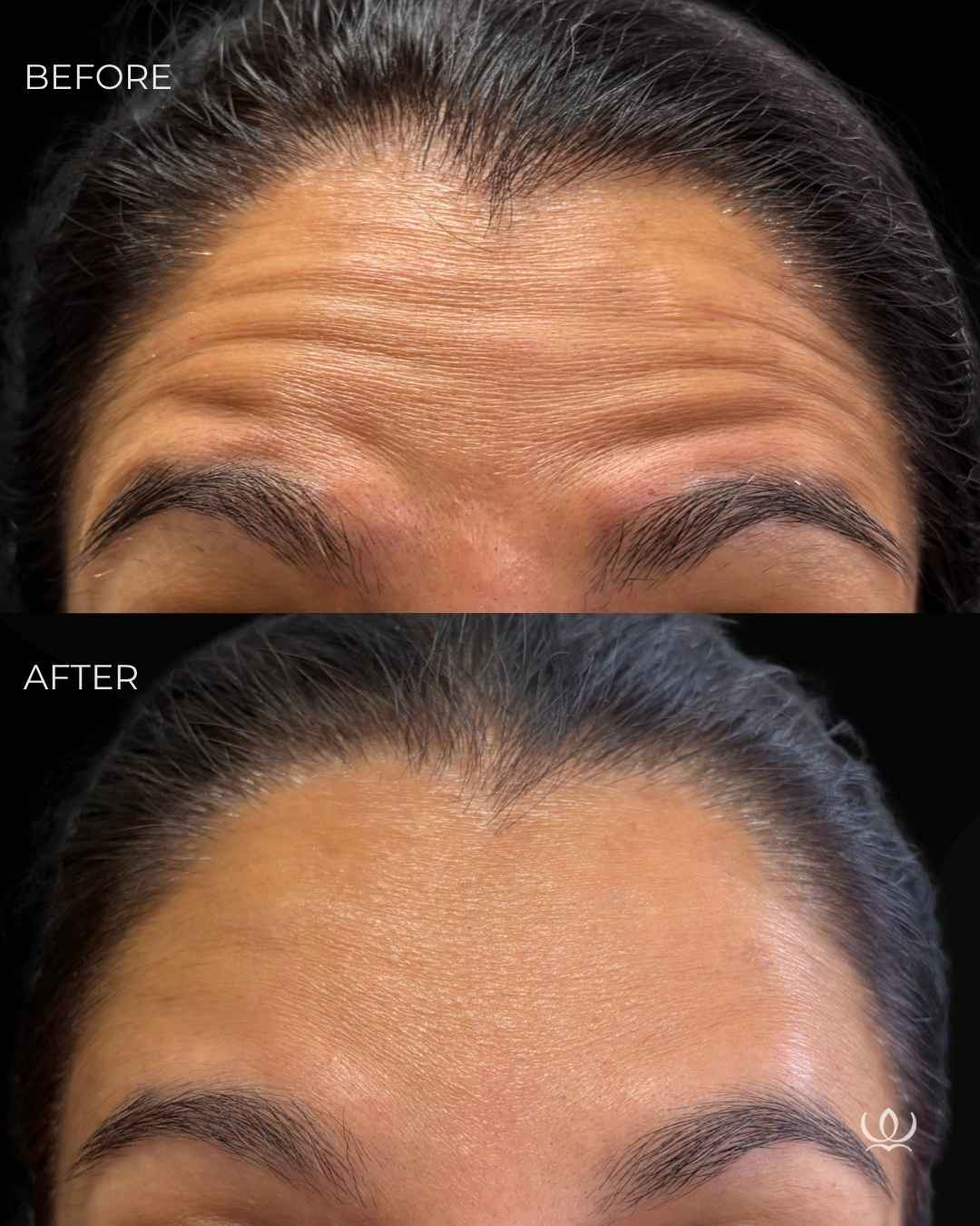 Forehead lines before and after — West Empire Aesthetics, Brentwood