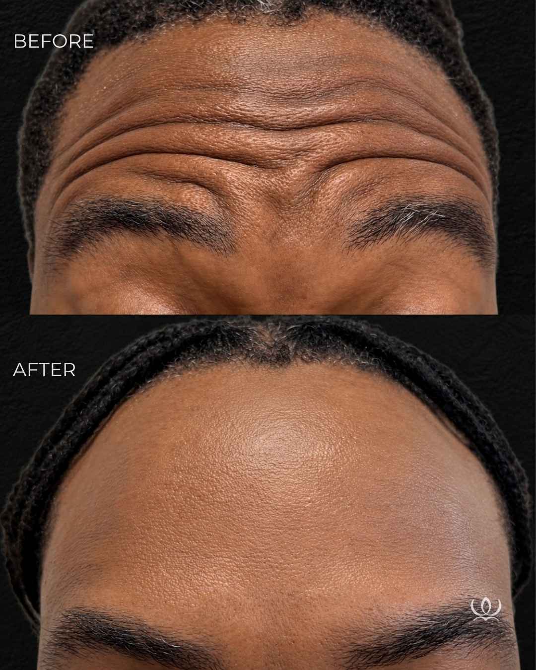 Forehead lines before and after — West Empire Aesthetics, Brentwood
