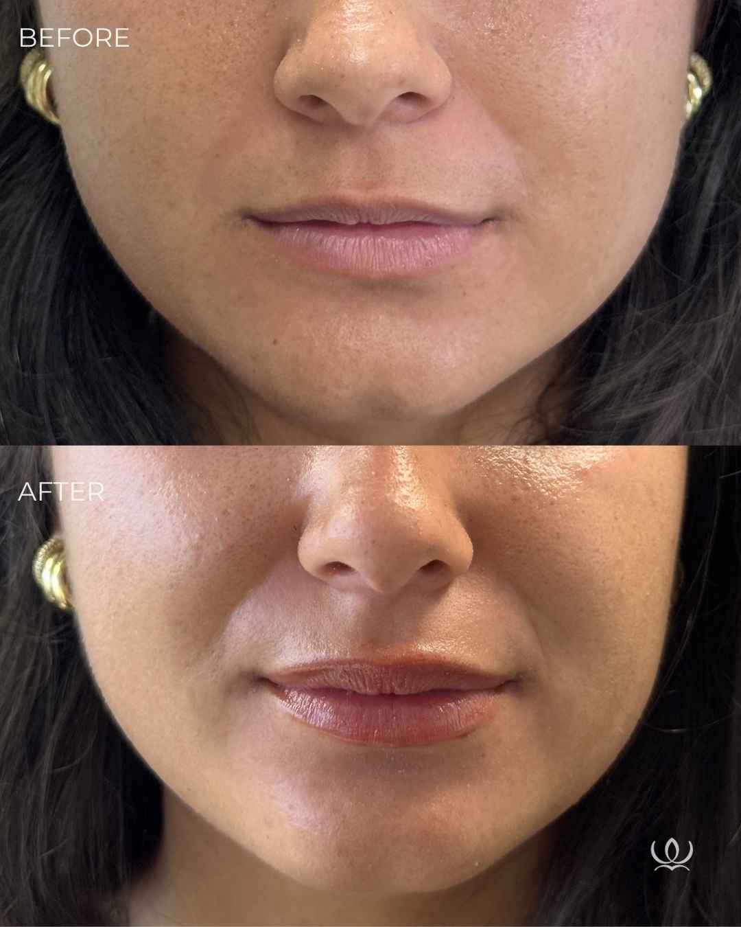 Lip flip before and after — West Empire Aesthetics, Brentwood