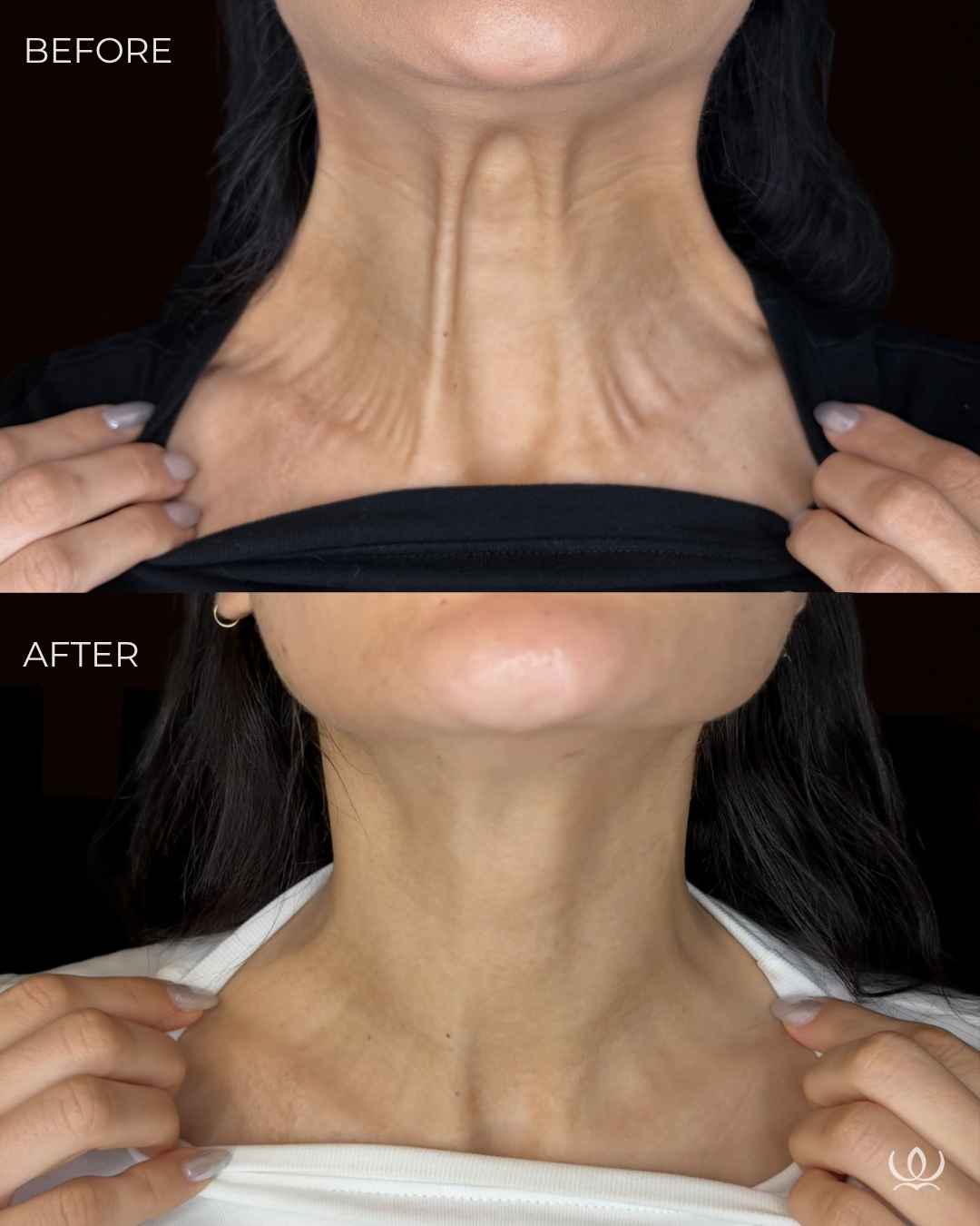 Platysmal bands before and after — West Empire Aesthetics, Brentwood