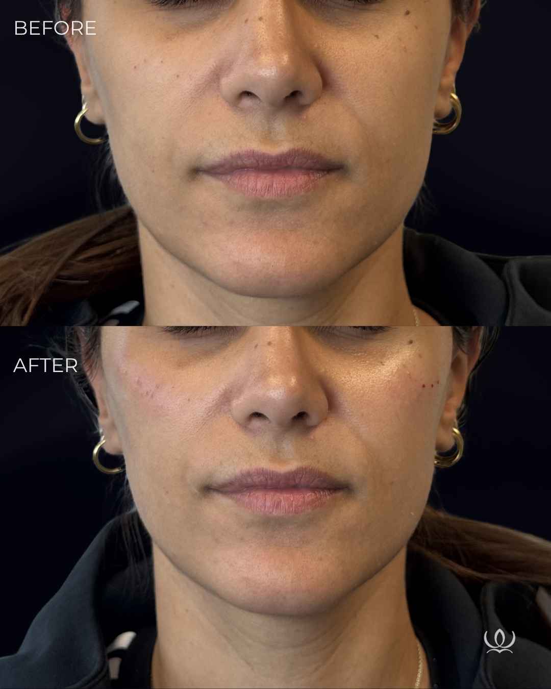 Cheek filler before and after — West Empire Aesthetics, Brentwood