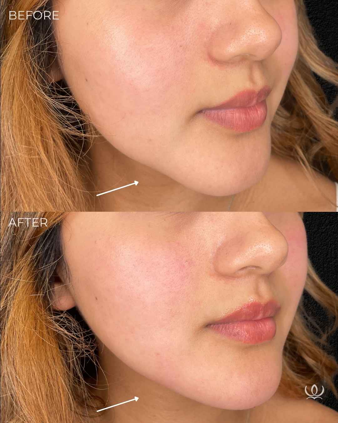 Chin filler before and after — West Empire Aesthetics, Brentwood