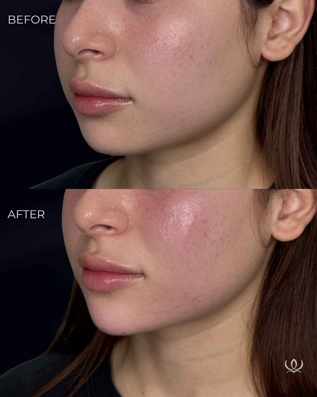 Chin filler before and after — West Empire Aesthetics, Brentwood