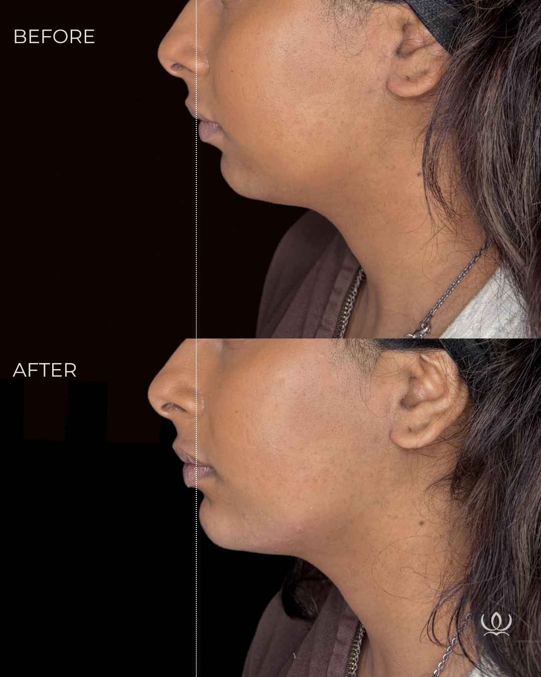 Chin filler before and after — West Empire Aesthetics, Brentwood