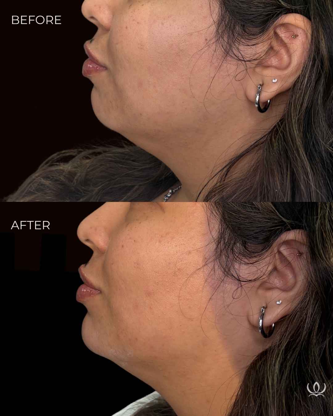 Chin filler before and after — West Empire Aesthetics, Brentwood