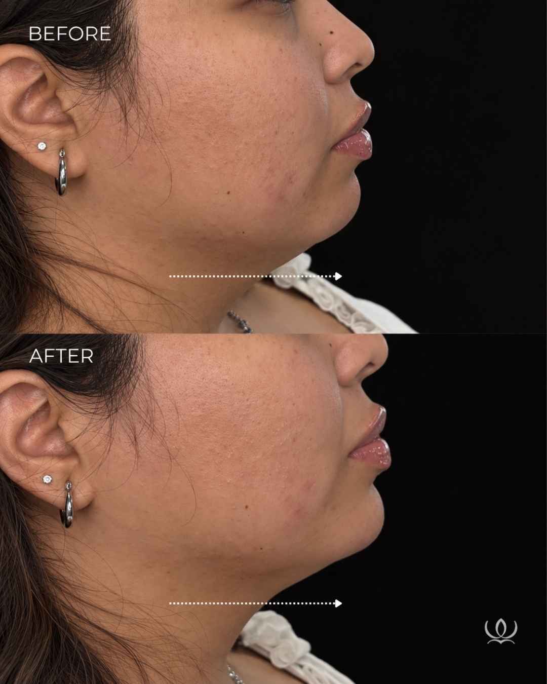 Chin filler before and after — West Empire Aesthetics, Brentwood