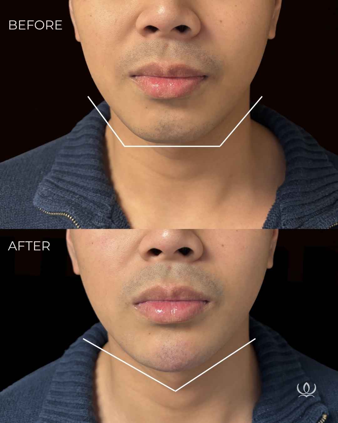 Chin filler before and after — West Empire Aesthetics, Brentwood