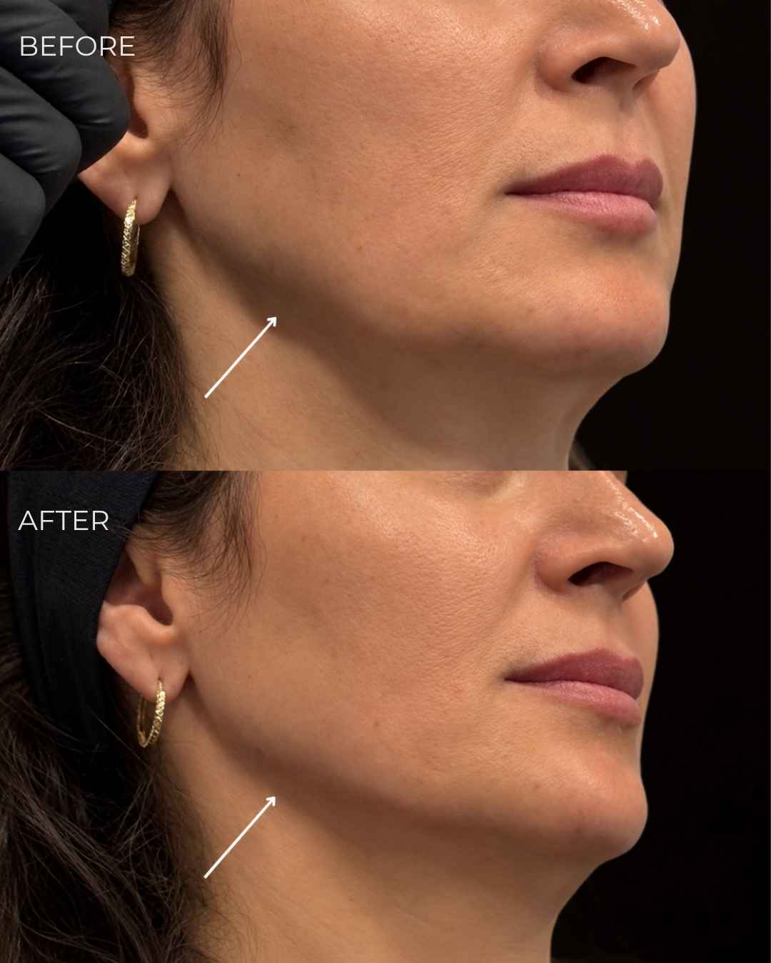 Jawline filler before and after — West Empire Aesthetics, Brentwood