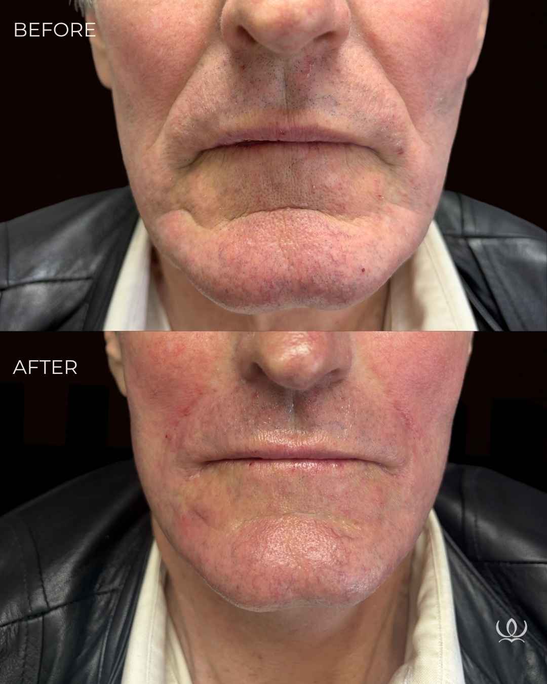 Lower-face rejuvenation before and after — West Empire Aesthetics, Brentwood