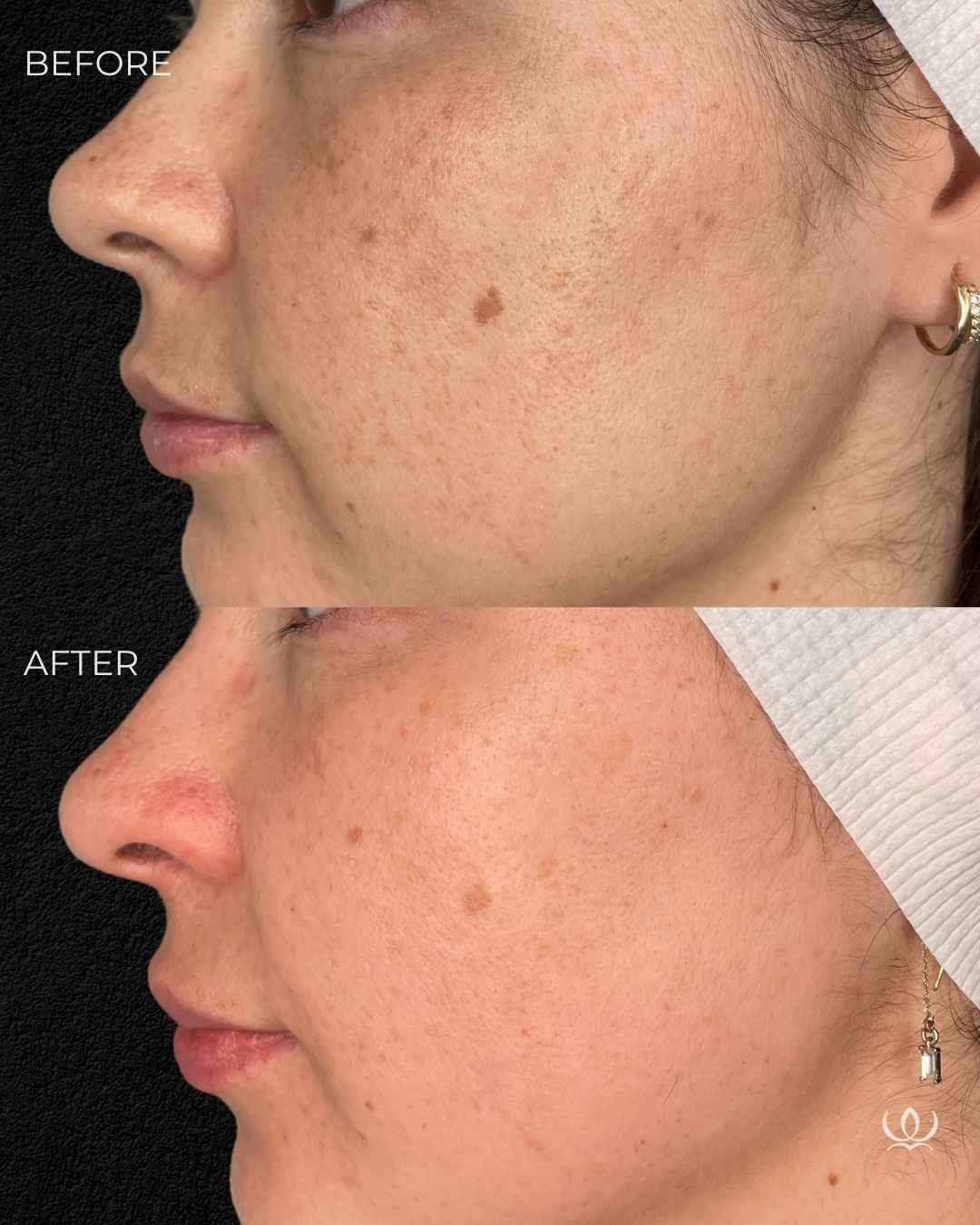CO2 CoolPeel before and after — West Empire Aesthetics, Brentwood