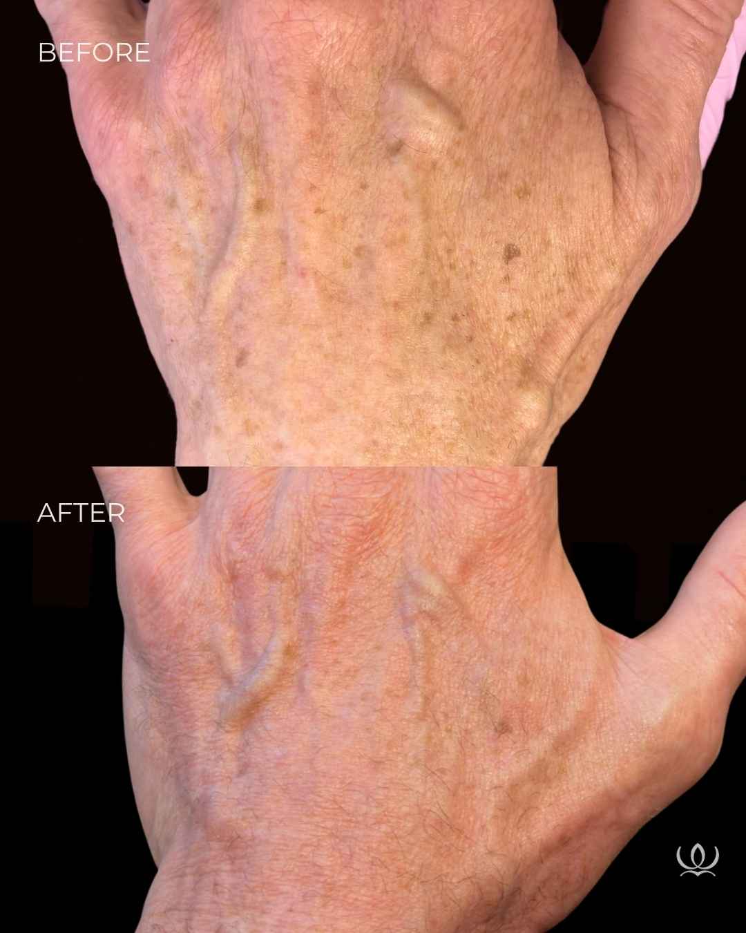 CO2 CoolPeel before and after — West Empire Aesthetics, Brentwood