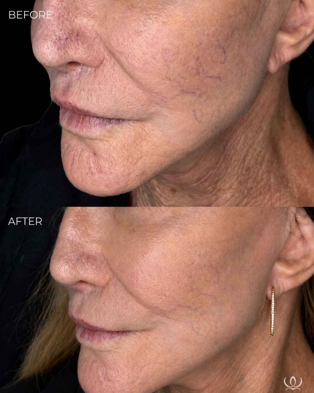 CoolPeel + VBeam before and after — West Empire Aesthetics, Brentwood