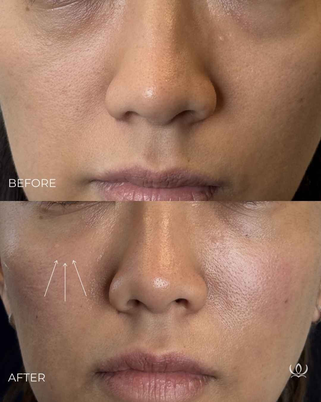 EZ Gel before and after — West Empire Aesthetics, Brentwood