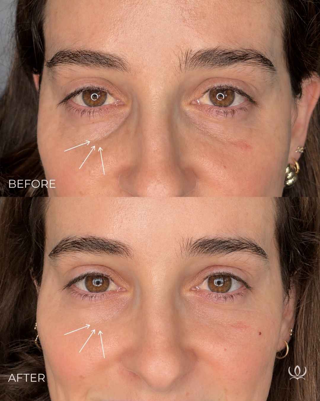 EZ Gel before and after — West Empire Aesthetics, Brentwood