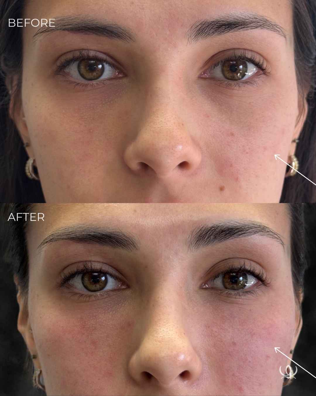 EZ Gel before and after — West Empire Aesthetics, Brentwood