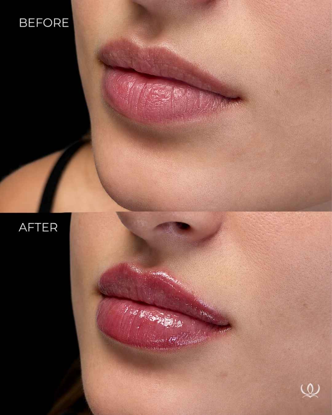 Lip filler before and after — West Empire Aesthetics, Brentwood