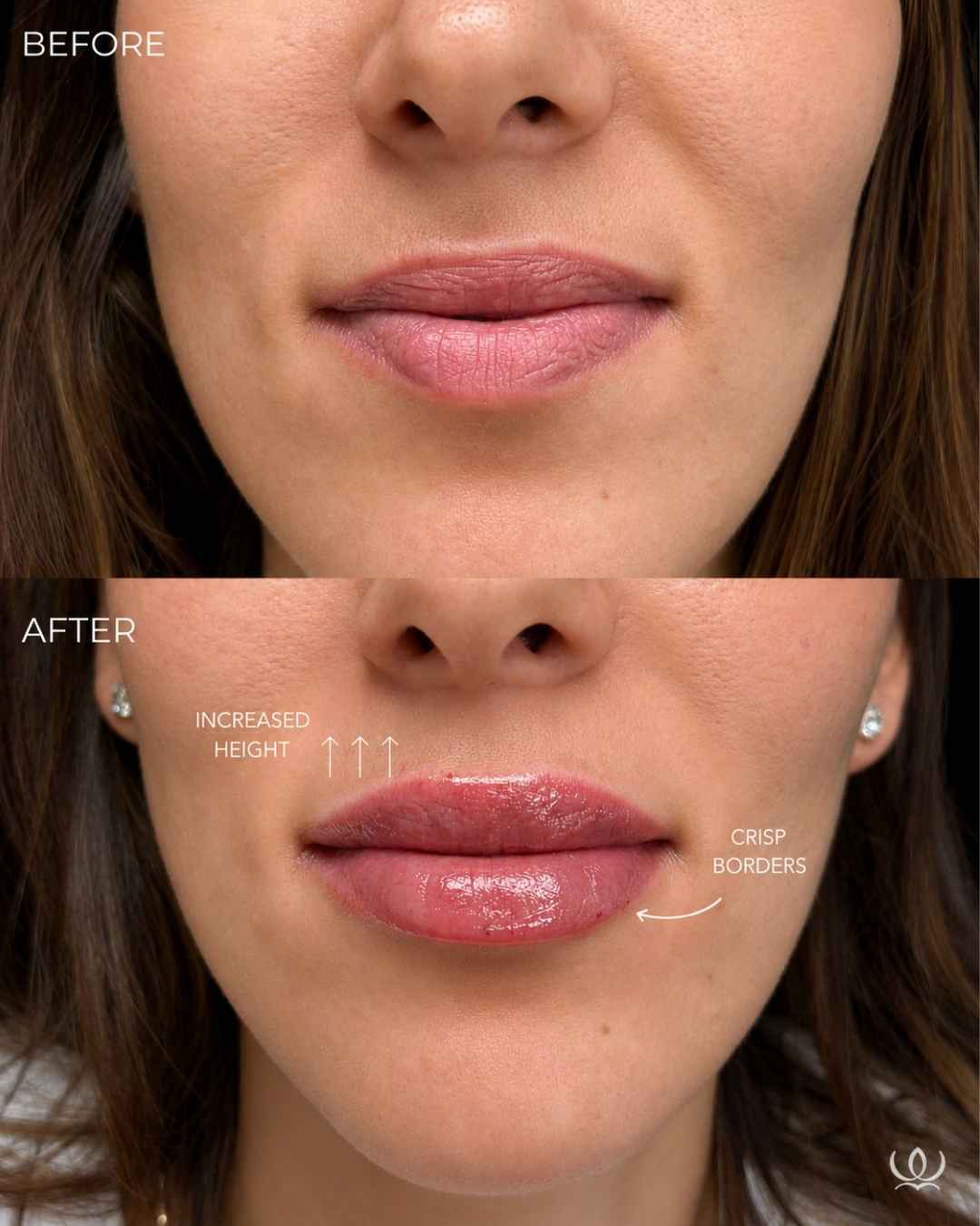 Lip filler before and after — West Empire Aesthetics, Brentwood