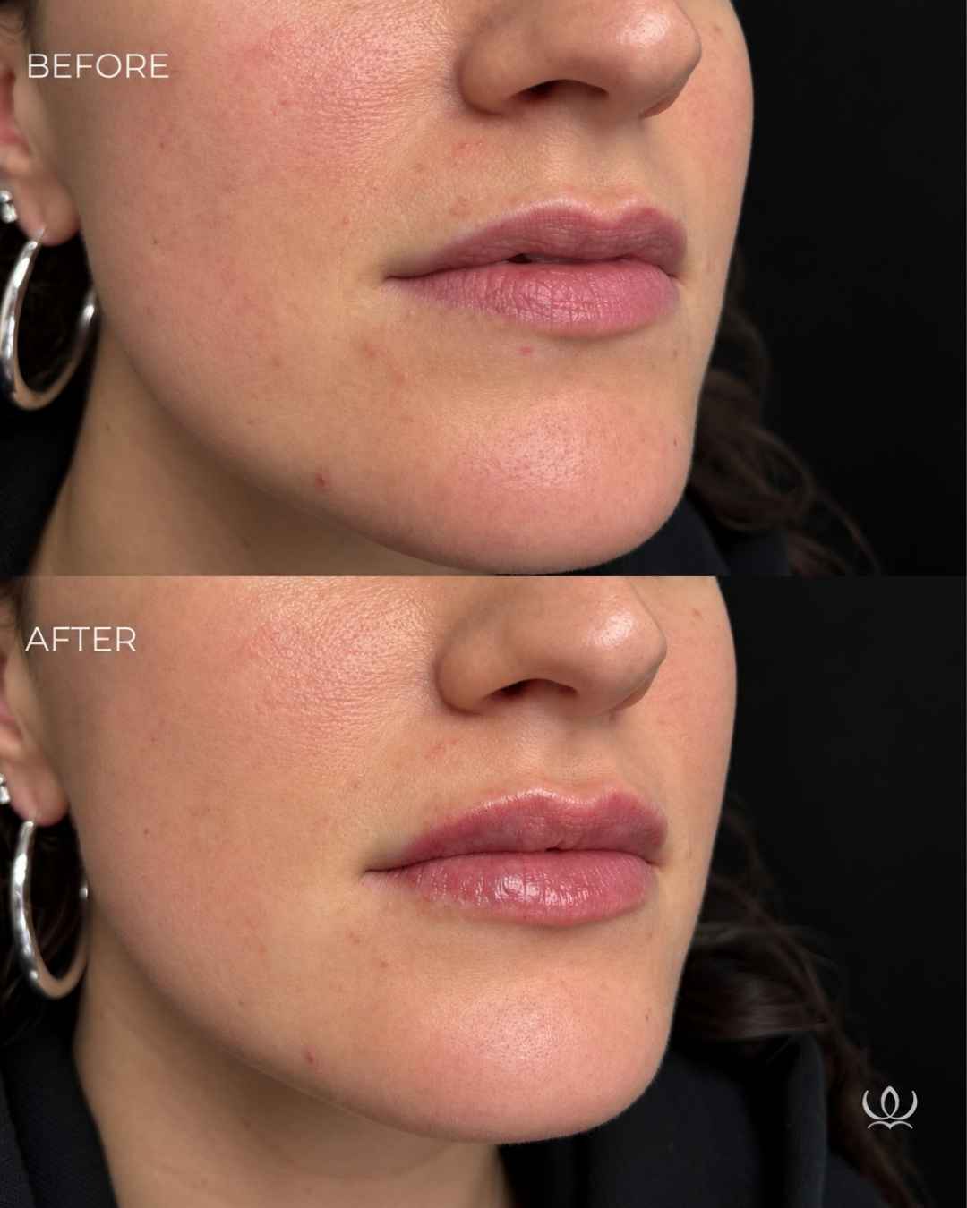 Lip filler before and after — West Empire Aesthetics, Brentwood