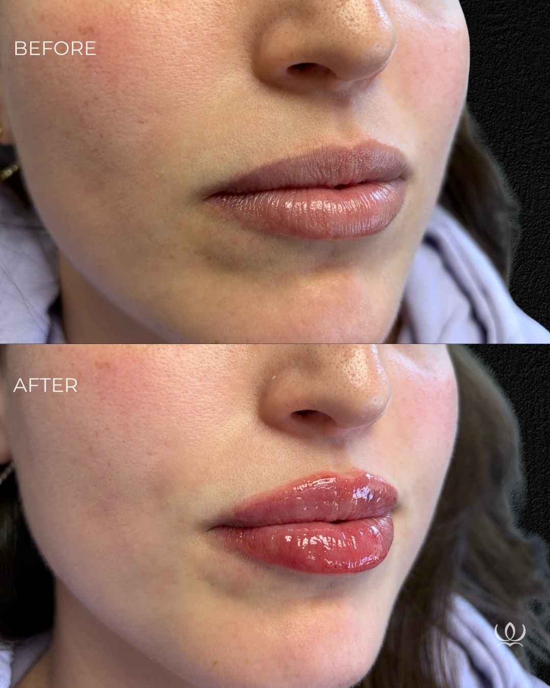 Lip filler before and after — West Empire Aesthetics, Brentwood