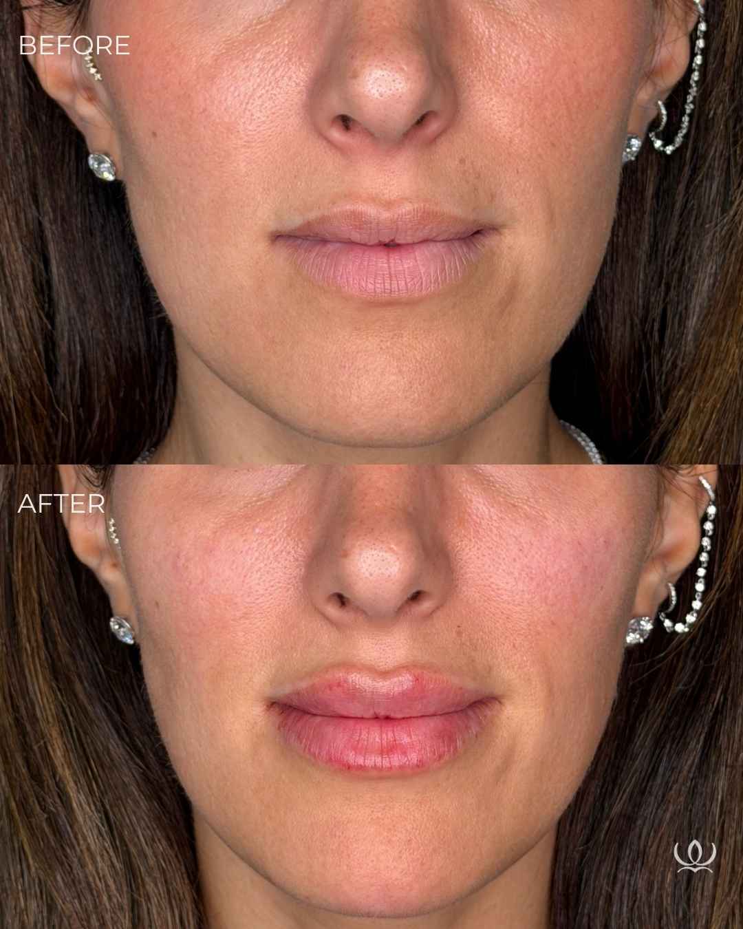 Lip filler before and after — West Empire Aesthetics, Brentwood