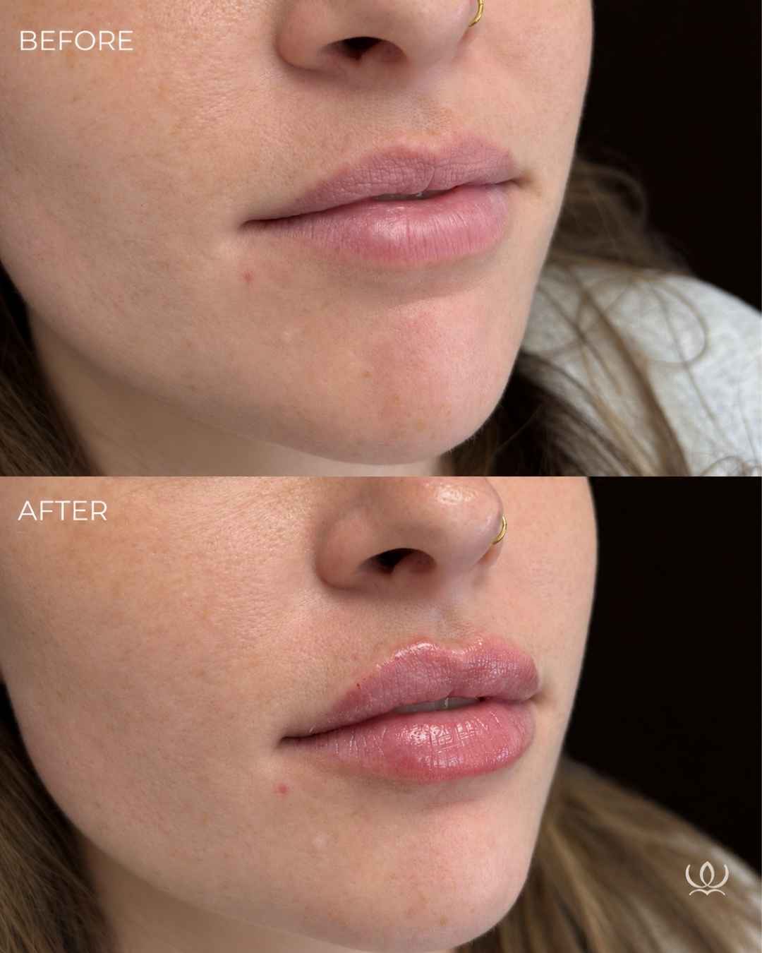 Lip filler before and after — West Empire Aesthetics, Brentwood