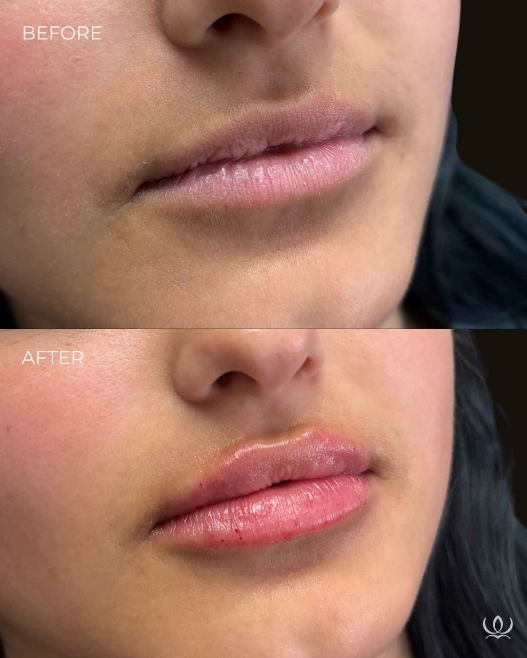 Lip filler before and after — West Empire Aesthetics, Brentwood