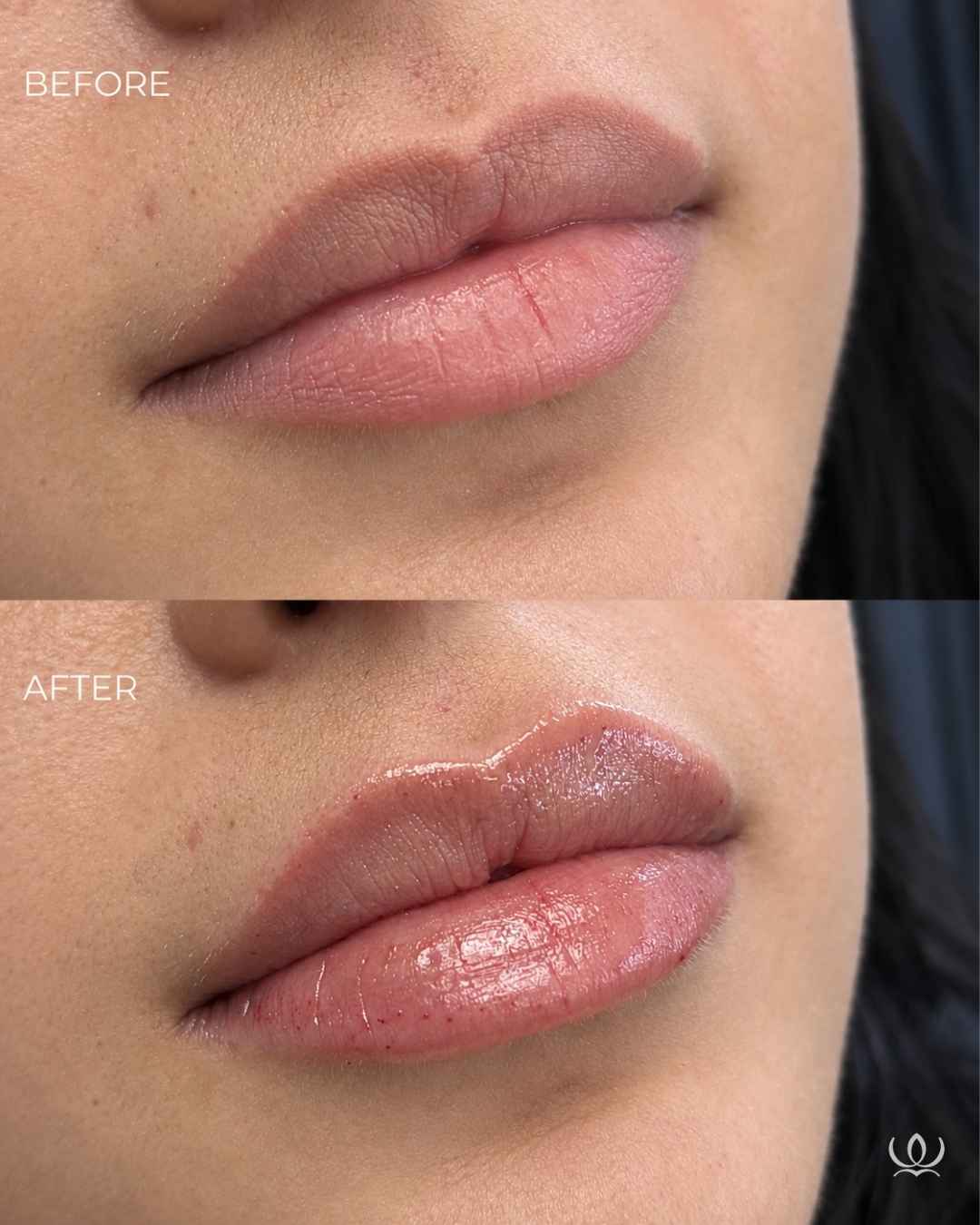 Lip filler before and after — West Empire Aesthetics, Brentwood