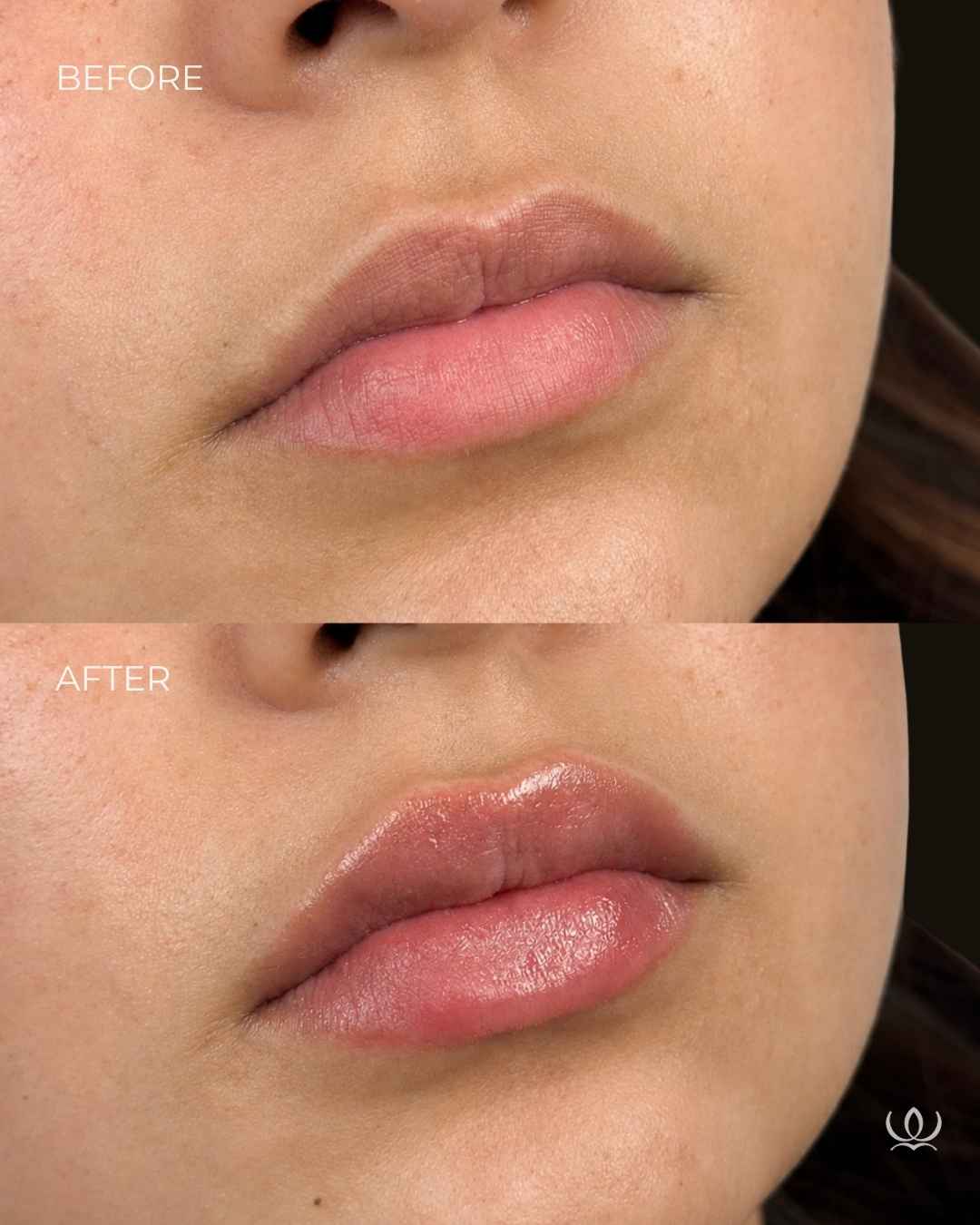 Lip filler before and after — West Empire Aesthetics, Brentwood