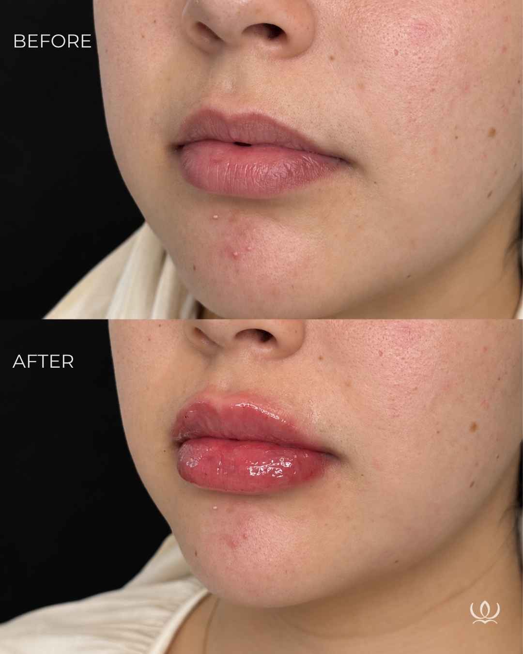 Lip filler before and after — West Empire Aesthetics, Brentwood