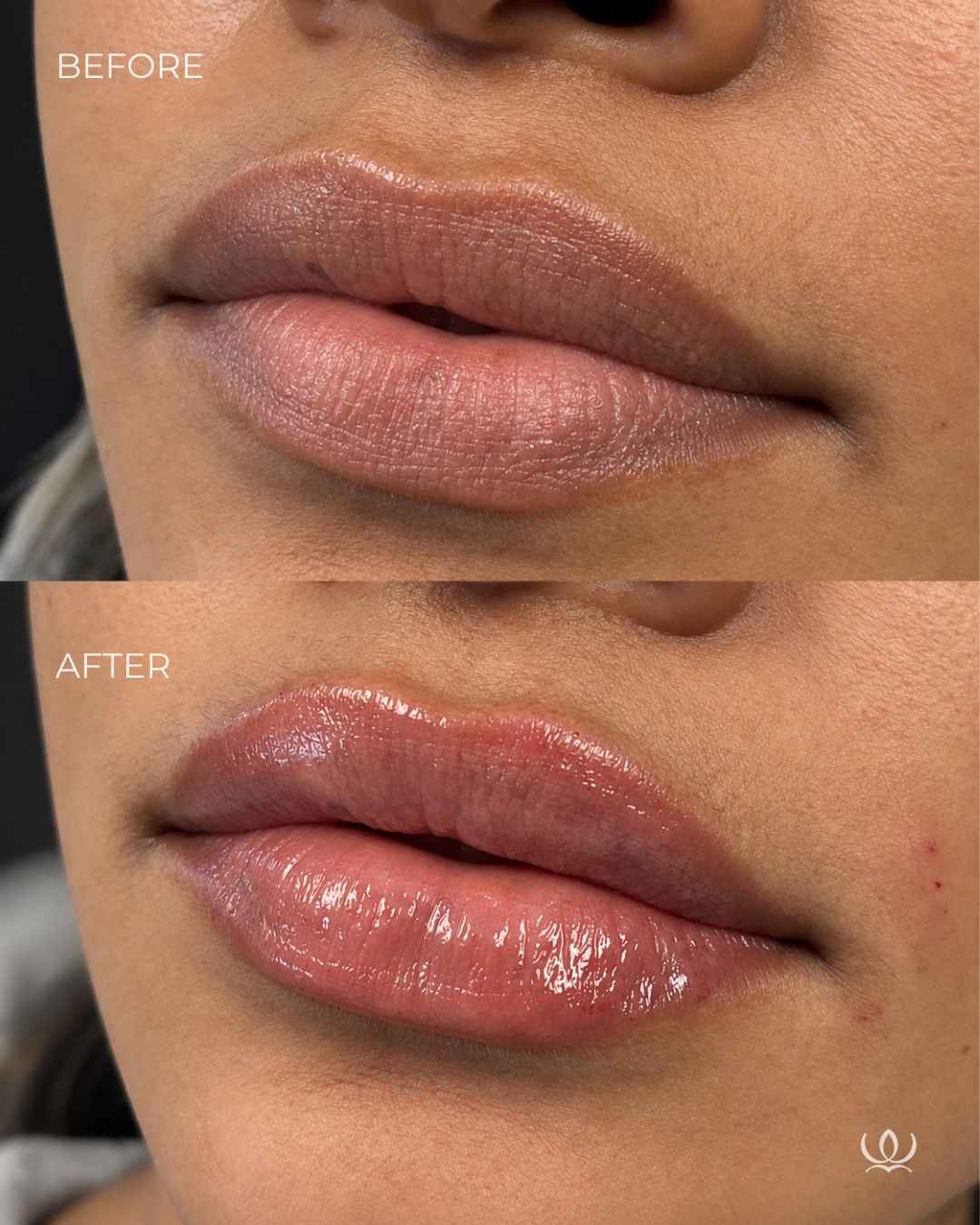 Lip filler before and after — West Empire Aesthetics, Brentwood