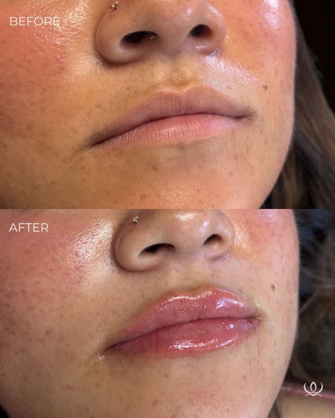Lip filler before and after — West Empire Aesthetics, Brentwood