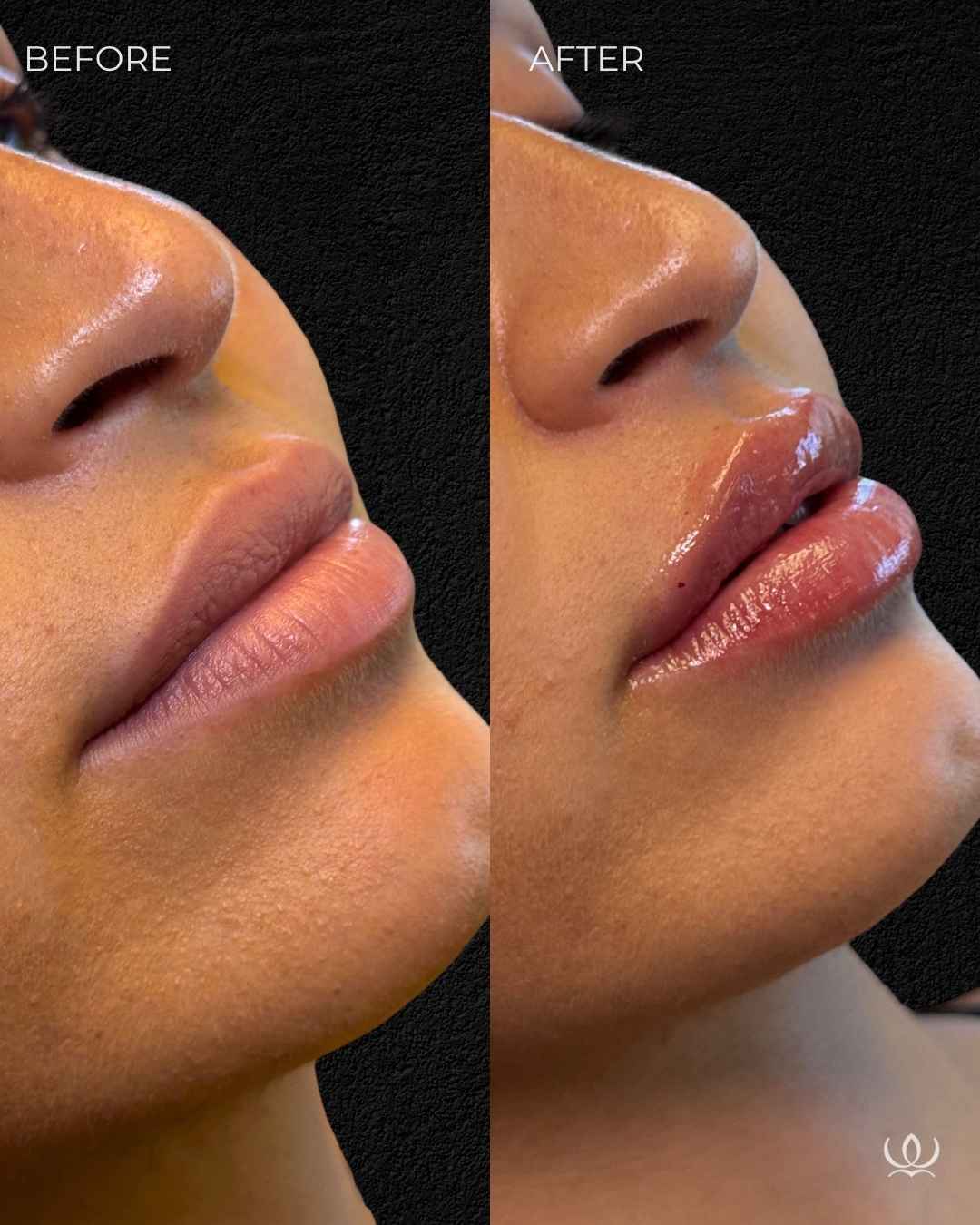 Lip filler before and after — West Empire Aesthetics, Brentwood