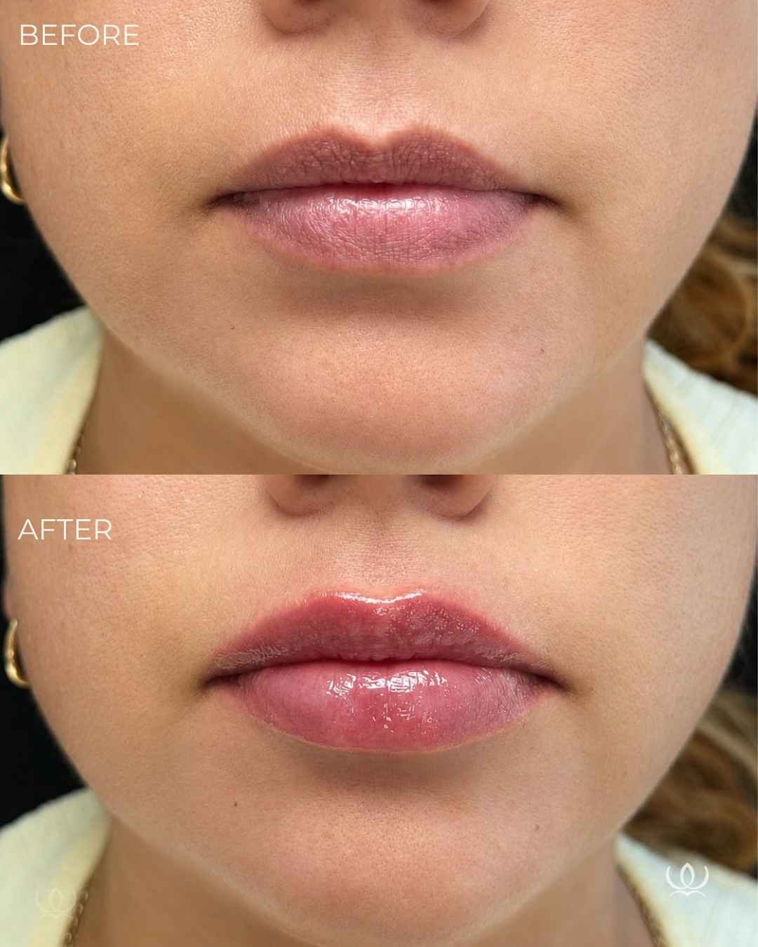 Lip filler before and after — West Empire Aesthetics, Brentwood