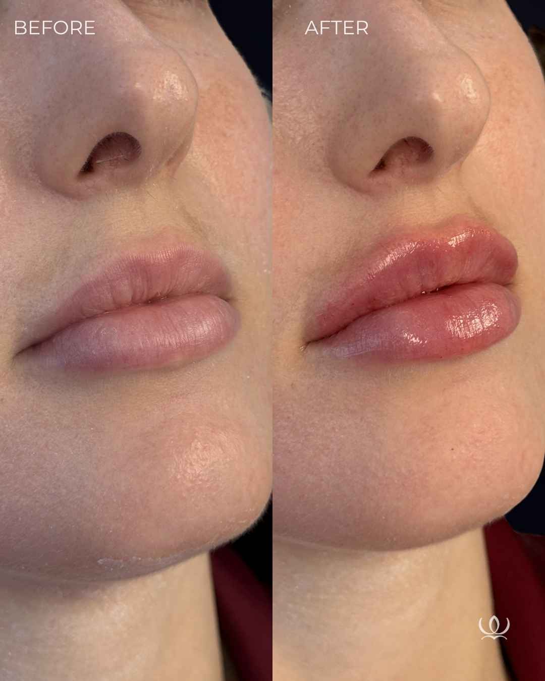 Lip filler before and after — West Empire Aesthetics, Brentwood