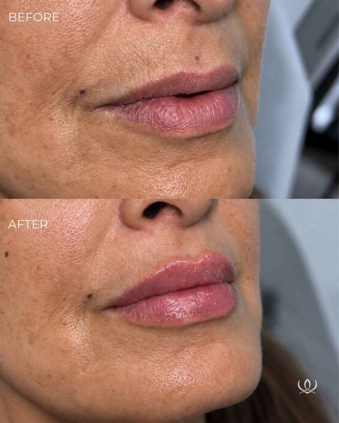 Lip filler before and after — West Empire Aesthetics, Brentwood