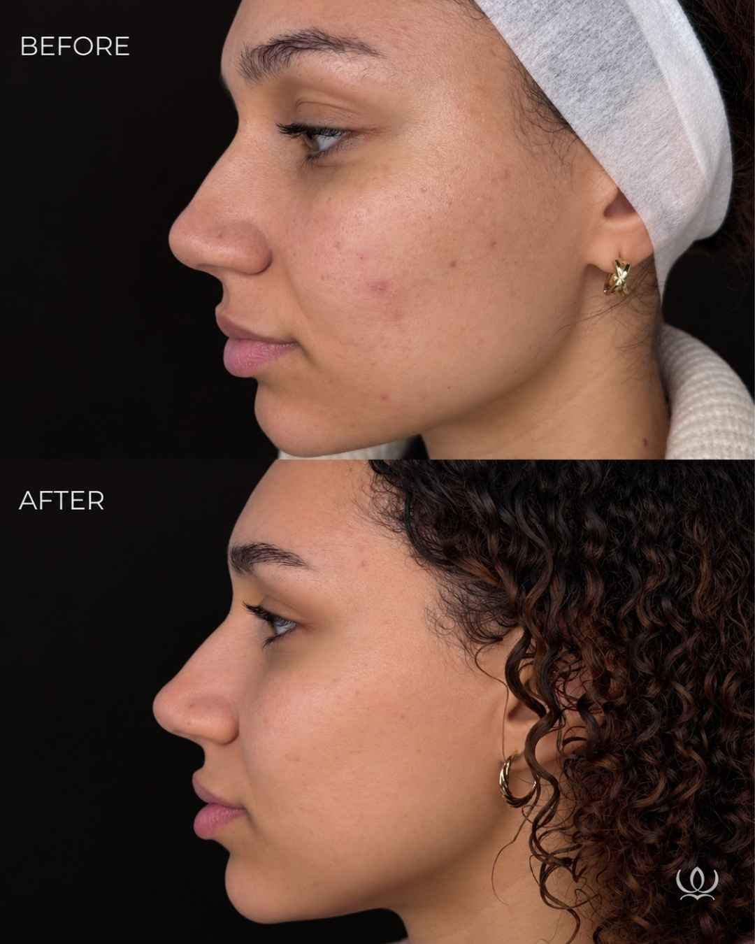 Microneedling + HA before and after — West Empire Aesthetics, Brentwood