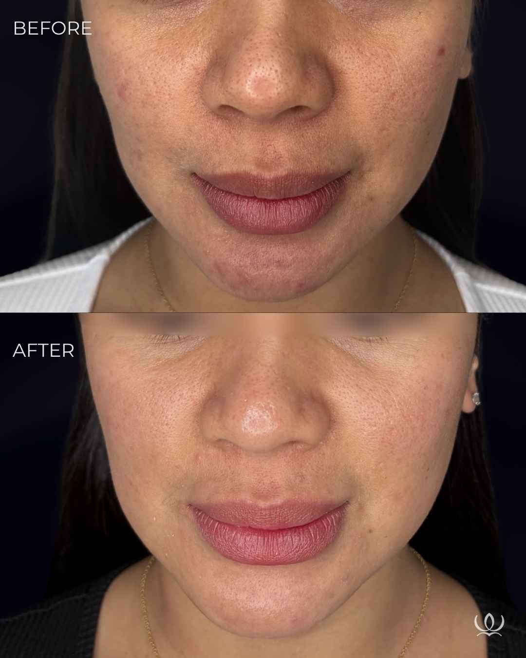 Microneedling + PRP before and after — West Empire Aesthetics, Brentwood