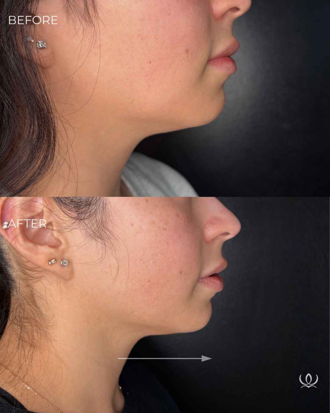 Morpheus8 before and after — West Empire Aesthetics, Brentwood
