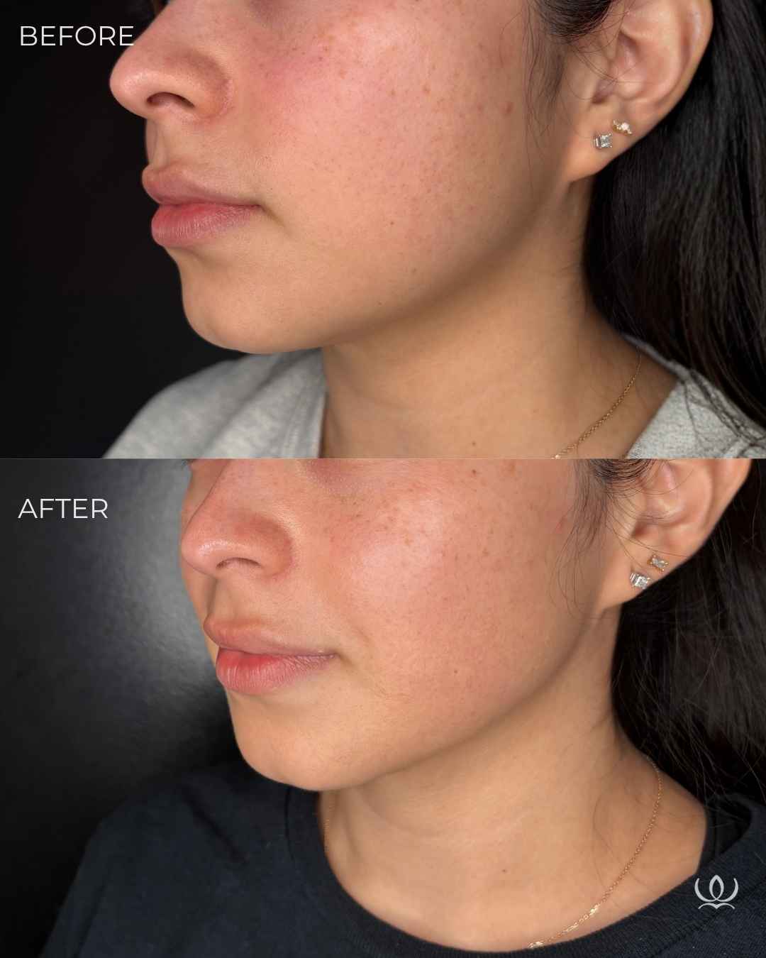 Morpheus8 before and after — West Empire Aesthetics, Brentwood