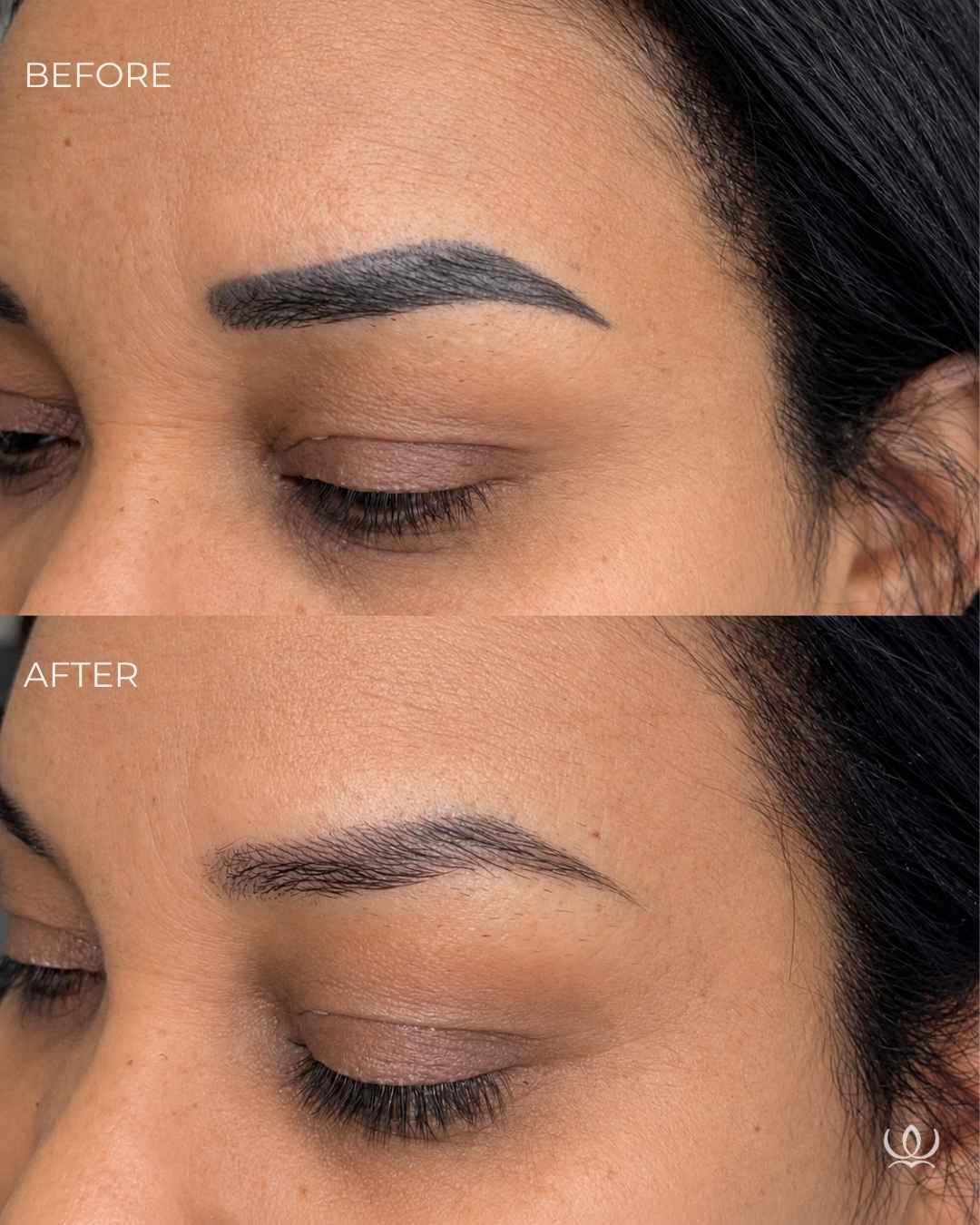Eyebrow tattoo removal before and after — West Empire Aesthetics, Brentwood