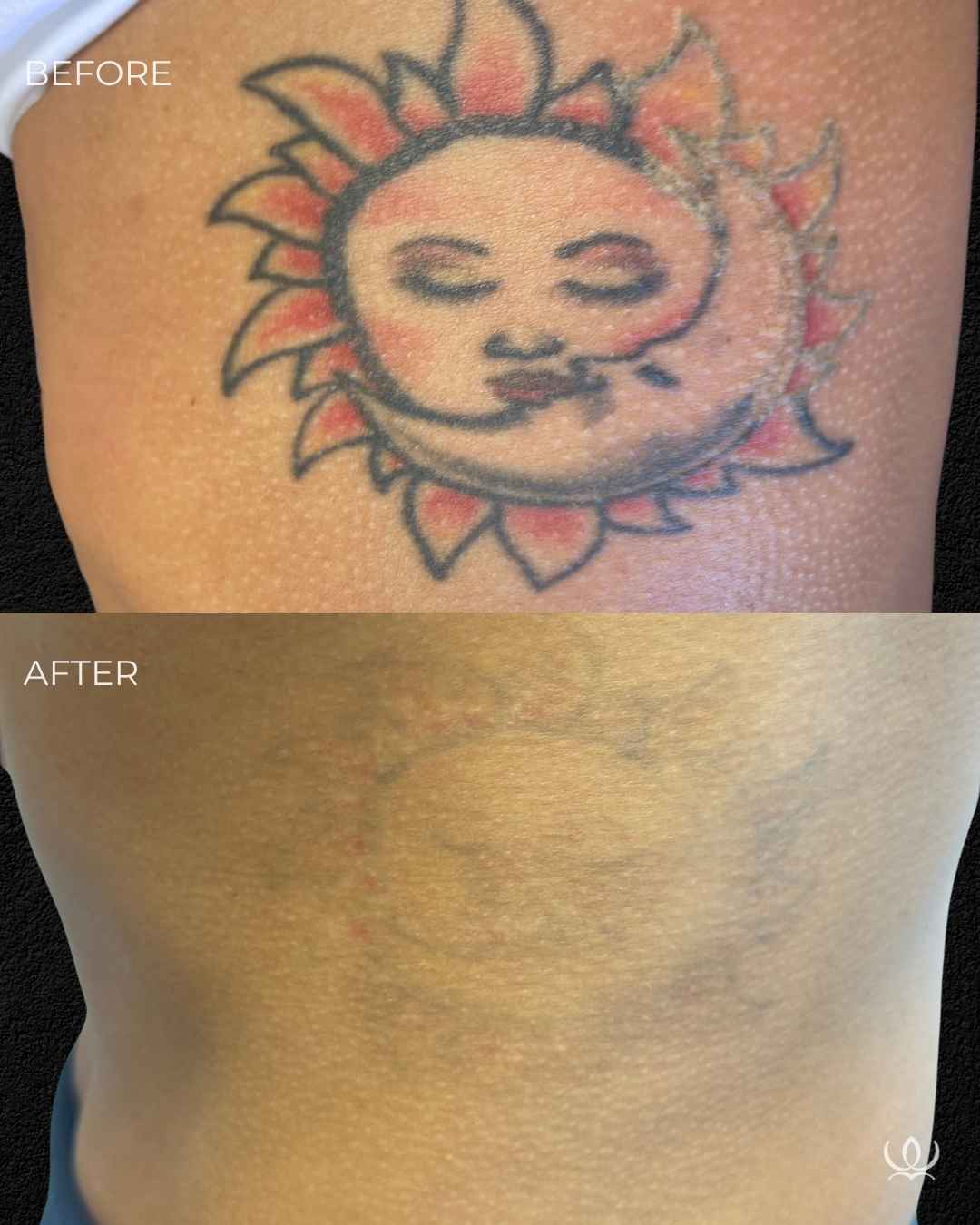 Tattoo removal before and after — West Empire Aesthetics, Brentwood