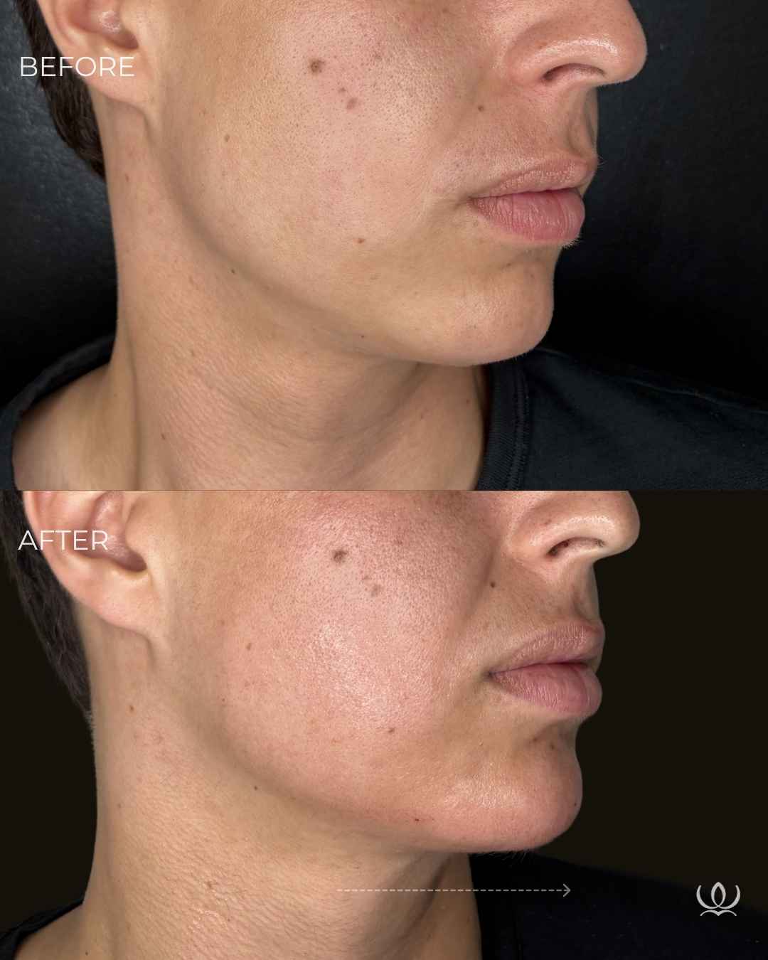 Sculptra — chin & jawline before and after — West Empire Aesthetics, Brentwood