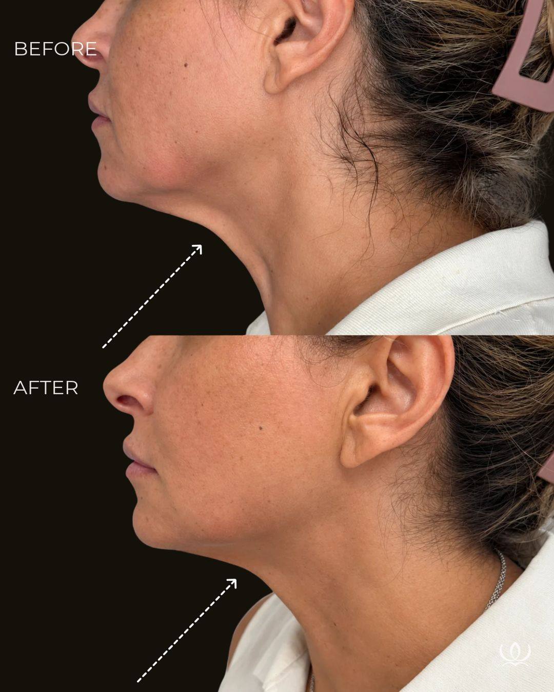 Thermage FLX® — lower face & neck before and after at West Empire Aesthetics